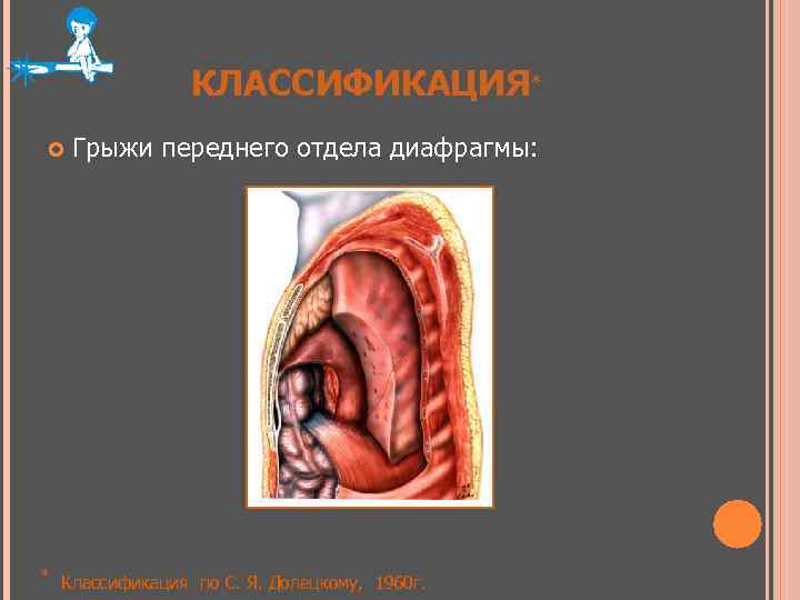 КЛАССИФИКАЦИЯ* * Грыжи переднего отдела диафрагмы: Классификация по С. Я. Долецкому, 1960 г. 