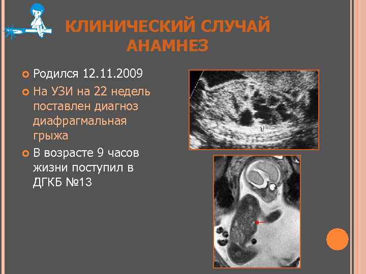 КЛИНИЧЕСКИЙ СЛУЧАЙ АНАМНЕЗ Родился 12. 11. 2009 На УЗИ на 22 недель поставлен диагноз