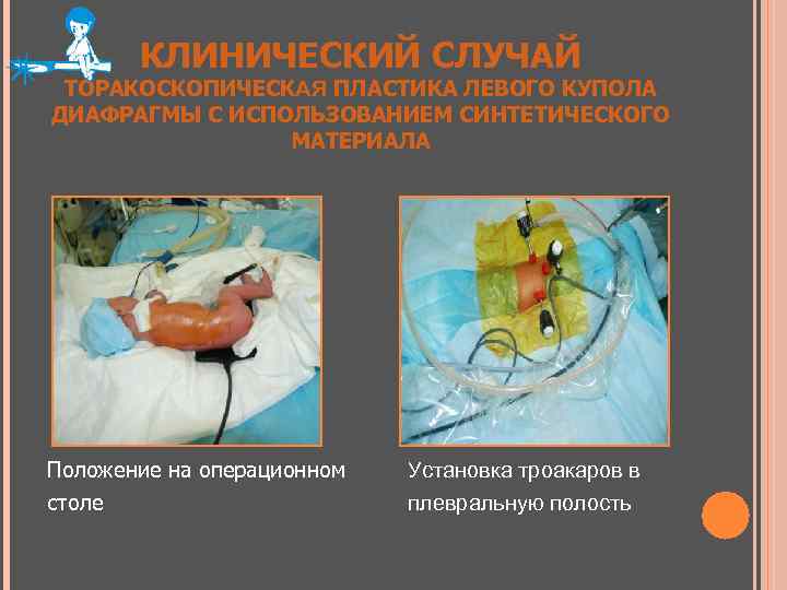 КЛИНИЧЕСКИЙ СЛУЧАЙ ТОРАКОСКОПИЧЕСКАЯ ПЛАСТИКА ЛЕВОГО КУПОЛА ДИАФРАГМЫ С ИСПОЛЬЗОВАНИЕМ СИНТЕТИЧЕСКОГО МАТЕРИАЛА Положение на операционном