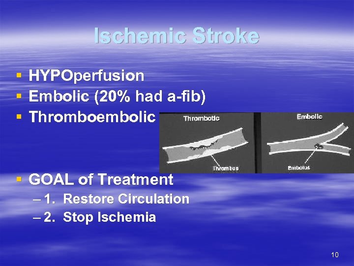 Ischemic Stroke § § § HYPOperfusion Embolic (20% had a-fib) Thromboembolic § GOAL of