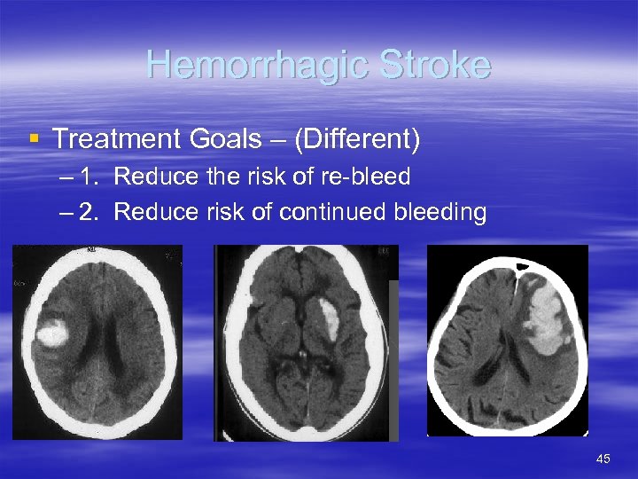 Hemorrhagic Stroke § Treatment Goals – (Different) – 1. Reduce the risk of re-bleed