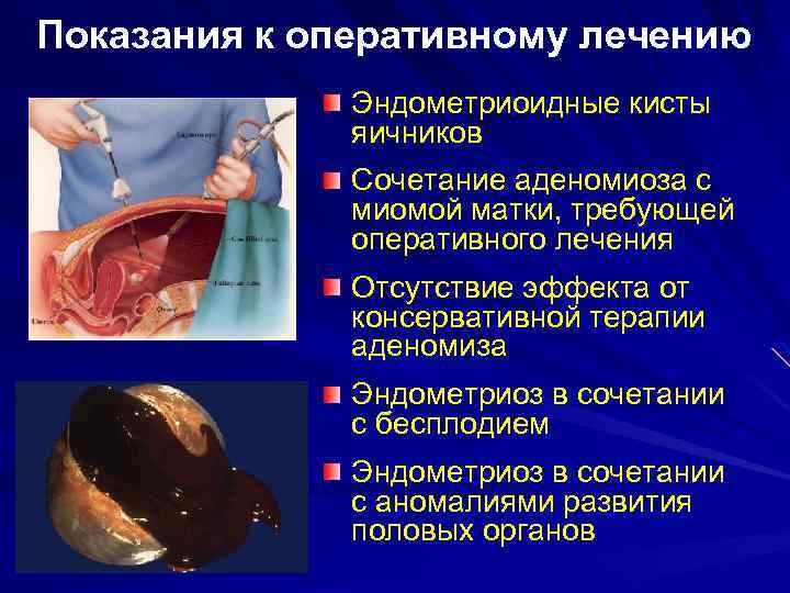 Показания к оперативному лечению Эндометриоидные кисты яичников Сочетание аденомиоза с миомой матки, требующей оперативного