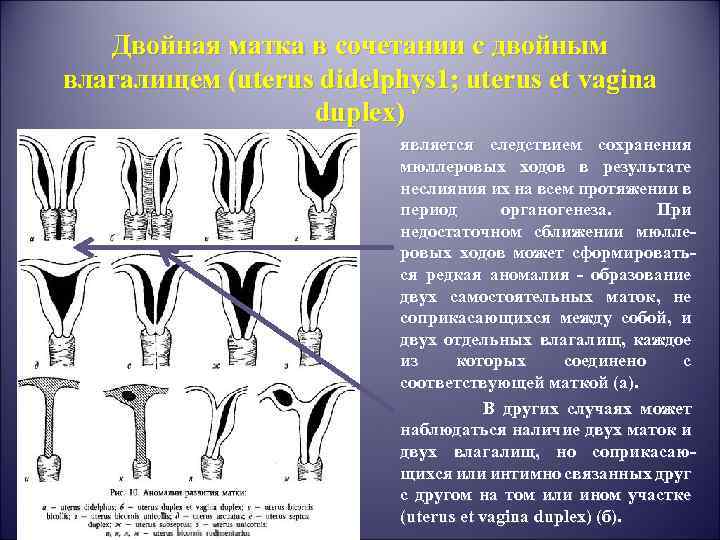 Двойная матка в сочетании с двойным влагалищем (uterus didelphys 1; uterus et vagina duplex)