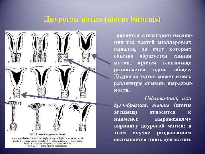 Двурогая матка (uterus bicornis) является следствием неслияния тех частей мюллеровых каналов, за счет которых
