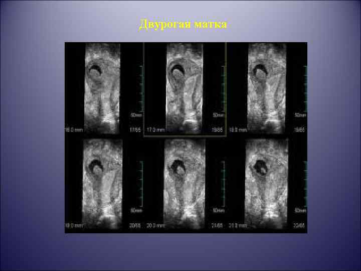 Двурогая матка 