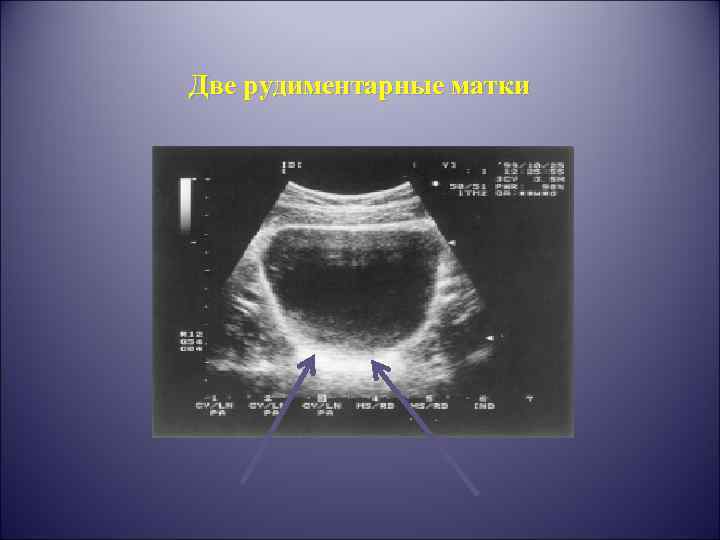 Две рудиментарные матки 
