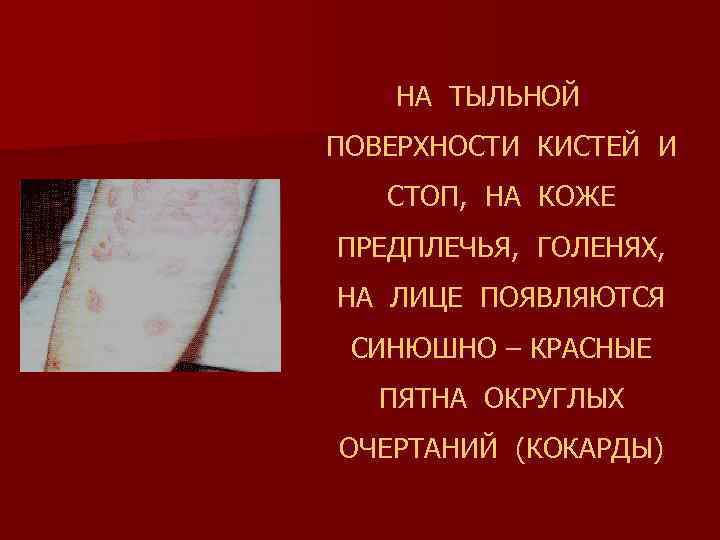 НА ТЫЛЬНОЙ ПОВЕРХНОСТИ КИСТЕЙ И СТОП, НА КОЖЕ ПРЕДПЛЕЧЬЯ, ГОЛЕНЯХ, НА ЛИЦЕ ПОЯВЛЯЮТСЯ СИНЮШНО