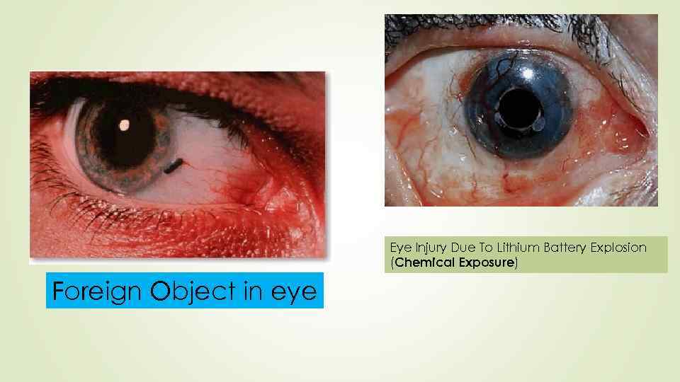 Eye Injury Due To Lithium Battery Explosion (Chemical Exposure) Foreign Object in eye 