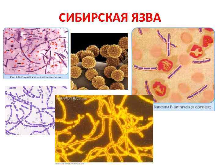 CИБИРСКАЯ ЯЗВА 