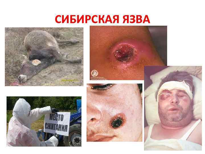 CИБИРСКАЯ ЯЗВА 