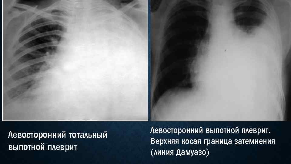 Левосторонний тотальный выпотной плеврит Левосторонний выпотной плеврит. Верхняя косая граница затемнения (линия Дамуазо) 