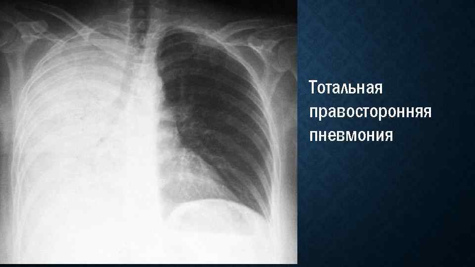 Тотальная правосторонняя пневмония 