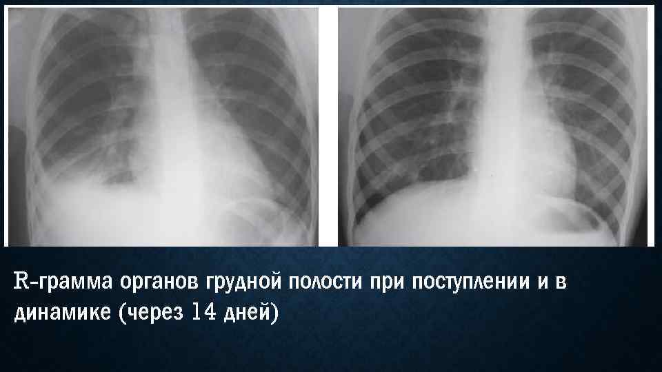 Рентген при пневмонии. Правосторонняя нижнедолевая пневмония рентген. Правосторонняя нижнедолевая очаговая пневмония рентген. Парапневмонический плеврит рентген. Среднедолевой синдром рентген.