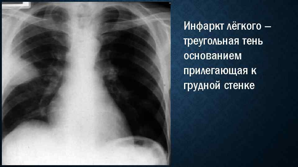 Инфаркт лёгкого – треугольная тень основанием прилегающая к грудной стенке 