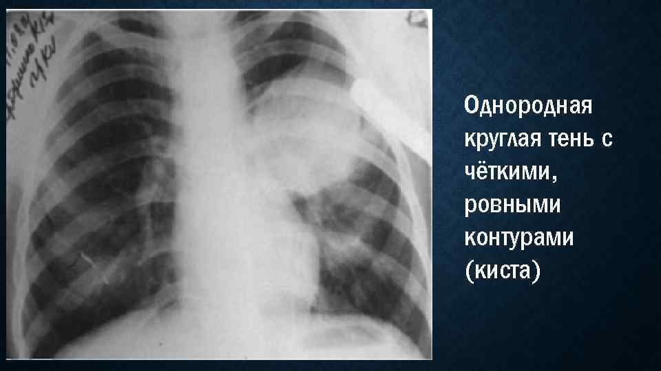 С ровными четкими контурами. Эхинококкоз легкого рентген. Эхинококк в легких рентген. Эхинококкоз легкого рентгенограмма. Эхинококковая киста легкого рентген.