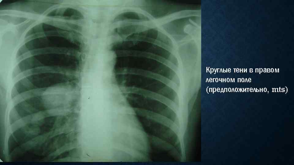 Круглые тени в правом легочном поле (предположительно, mts) 