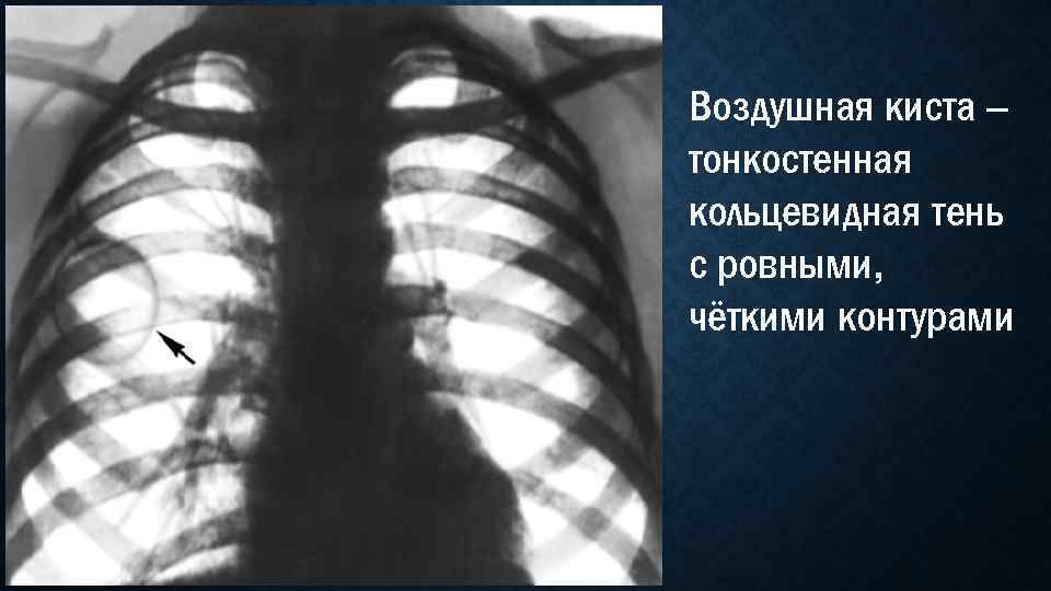 Воздушная киста – тонкостенная кольцевидная тень с ровными, чёткими контурами 