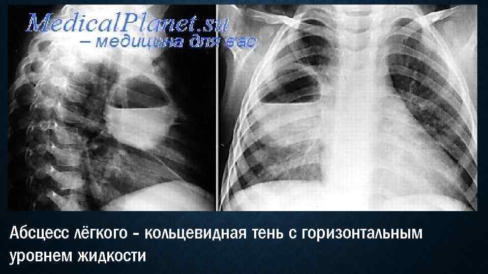 Абсцесс лёгкого - кольцевидная тень с горизонтальным уровнем жидкости 