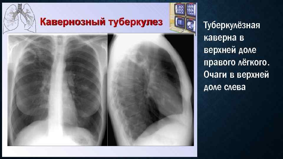 Туберкулёзная каверна в верхней доле правого лёгкого. Очаги в верхней доле слева 