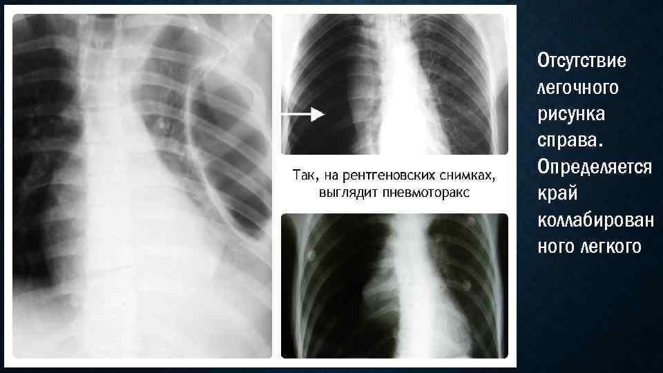 Отсутствие легочного рисунка справа. Определяется край коллабирован ного легкого 