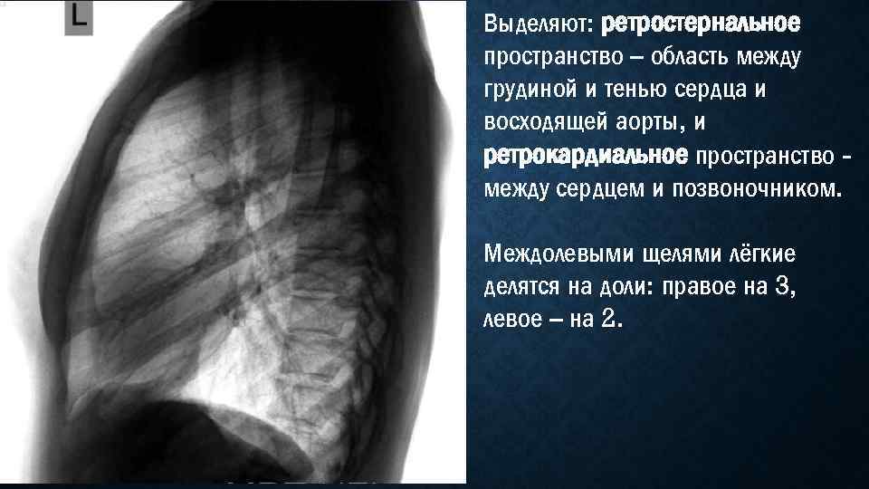 Выделяют: ретростернальное пространство – область между грудиной и тенью сердца и восходящей аорты, и