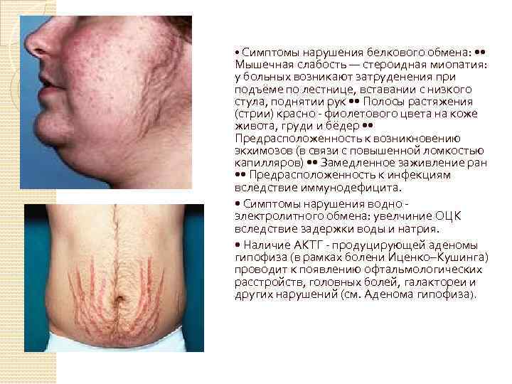  • Симптомы нарушения белкового обмена: • • Мышечная слабость — стероидная миопатия: у