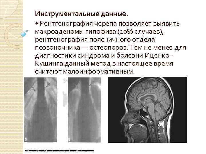 Макроаденома гипофиза