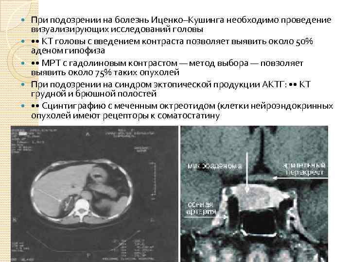  При подозрении на болезнь Иценко–Кушинга необходимо проведение визуализирующих исследований головы • • КТ