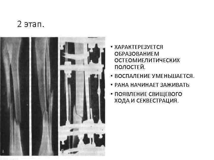 2 этап. • ХАРАКТЕРЕЗУЕТСЯ ОБРАЗОВАНИЕМ ОСТЕОМИЕЛИТИЧЕСКИХ ПОЛОСТЕЙ. • ВОСПАЛЕНИЕ УМЕНЬШАЕТСЯ. • РАНА НАЧИНАЕТ ЗАЖИВАТЬ
