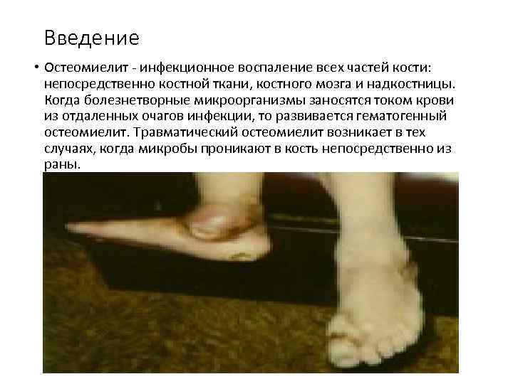 Введение • Остеомиелит инфекционное воспаление всех частей кости: непосредственно костной ткани, костного мозга и