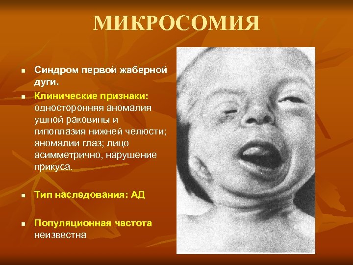 МИКРОСОМИЯ n n Синдром первой жаберной дуги. Клинические признаки: односторонняя аномалия ушной раковины и