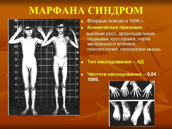 МАРФАНА СИНДРОМ n n Впервые описан в 1896 г. Клинические признаки: высокий рост, арахнодактилия,