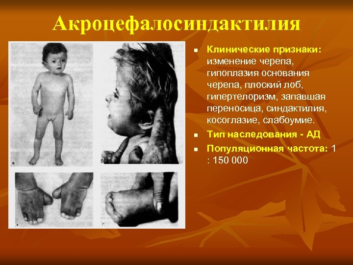 Акроцефалосиндактилия n n n Клинические признаки: изменение черепа, гипоплазия основания черепа, плоский лоб, гипертелоризм,