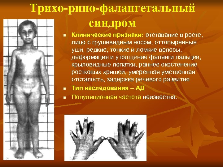 Трихо-рино-фалангетальный синдром n n n Клинические признаки: отставание в росте, лицо с грушевидным носом,