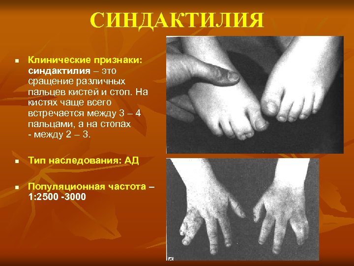 СИНДАКТИЛИЯ n n n Клинические признаки: синдактилия – это сращение различных пальцев кистей и
