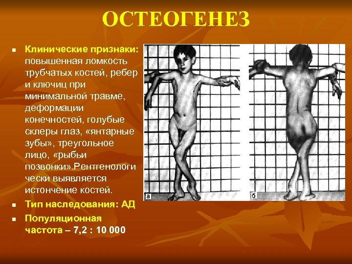 ОСТЕОГЕНЕЗ n n n Клинические признаки: повышенная ломкость трубчатых костей, ребер и ключиц при