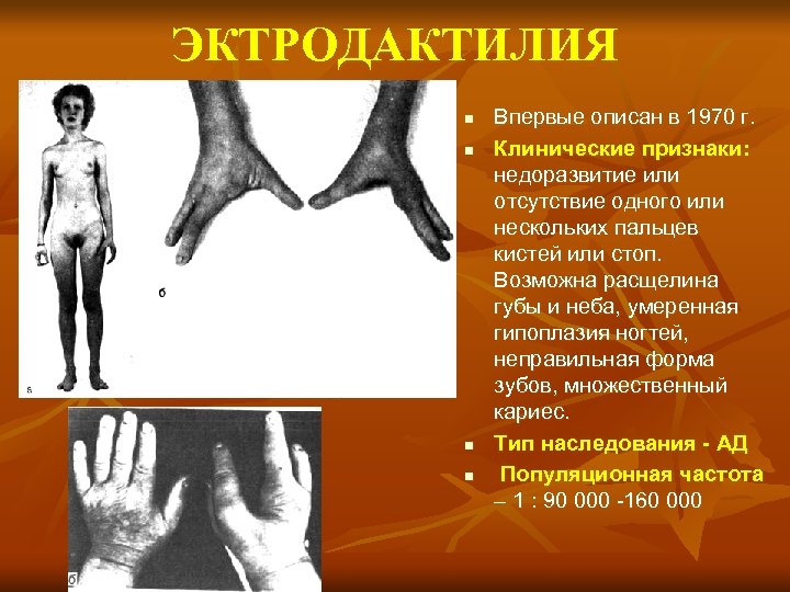 ЭКТРОДАКТИЛИЯ n n Впервые описан в 1970 г. Клинические признаки: недоразвитие или отсутствие одного