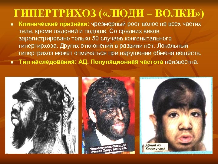 ГИПЕРТРИХОЗ ( «ЛЮДИ – ВОЛКИ» ) n n Клинические признаки: чрезмерный рост волос на
