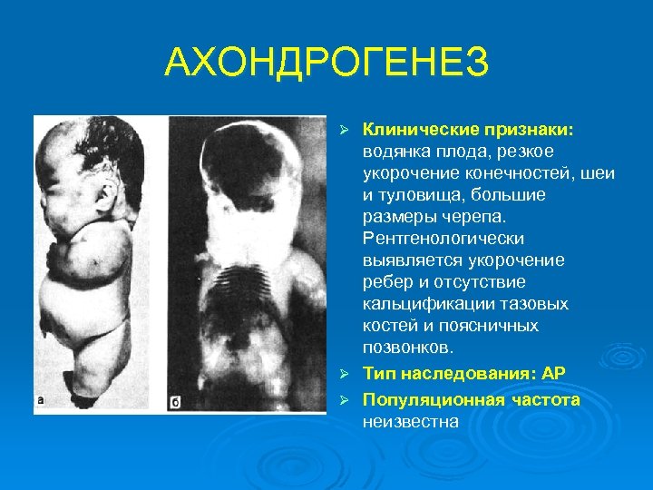АХОНДРОГЕНЕЗ Клинические признаки: водянка плода, резкое укорочение конечностей, шеи и туловища, большие размеры черепа.