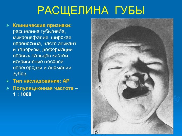 РАСЩЕЛИНА ГУБЫ Клинические признаки: расщелина губы/неба, микроцефалия, широкая переносица, часто эпикант и телоризм, деформации