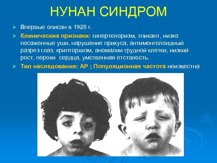 НУНАН СИНДРОМ Впервые описан в 1928 г. Ø Клинические признаки: гипертелоризм, эпикант, низко посаженные