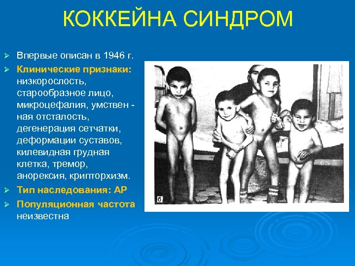 КОККЕЙНА СИНДРОМ Ø Ø Впервые описан в 1946 г. Клинические признаки: низкорослость, старообразное лицо,