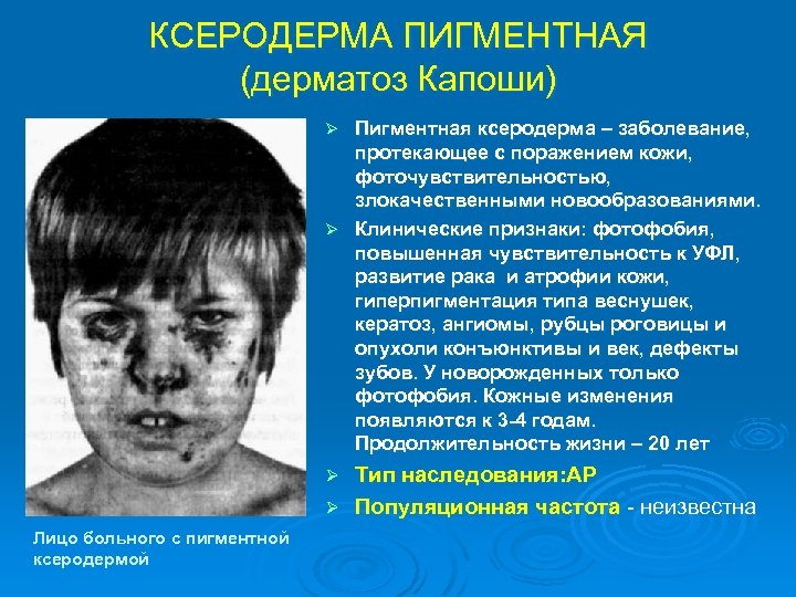 КСЕРОДЕРМА ПИГМЕНТНАЯ (дерматоз Капоши) Пигментная ксеродерма – заболевание, протекающее с поражением кожи, фоточувствительностью, злокачественными