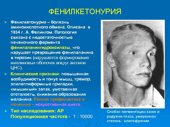 ФЕНИЛКЕТОНУРИЯ Фенилкетонурия – болезнь аминокислотного обмена. Описана в 1934 г. А. Фелингом. Патология связана