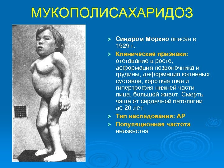 МУКОПОЛИСАХАРИДОЗ Ø Ø Синдром Моркио описан в 1929 г. Клинические признаки: отставание в росте,