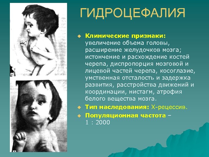 ГИДРОЦЕФАЛИЯ u u u Клинические признаки: увеличение объема головы, расширение желудочков мозга; истончение и