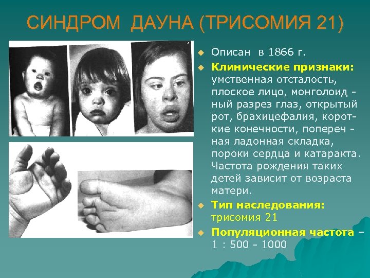 СИНДРОМ ДАУНА (ТРИСОМИЯ 21) u u Описан в 1866 г. Клинические признаки: умственная отсталость,