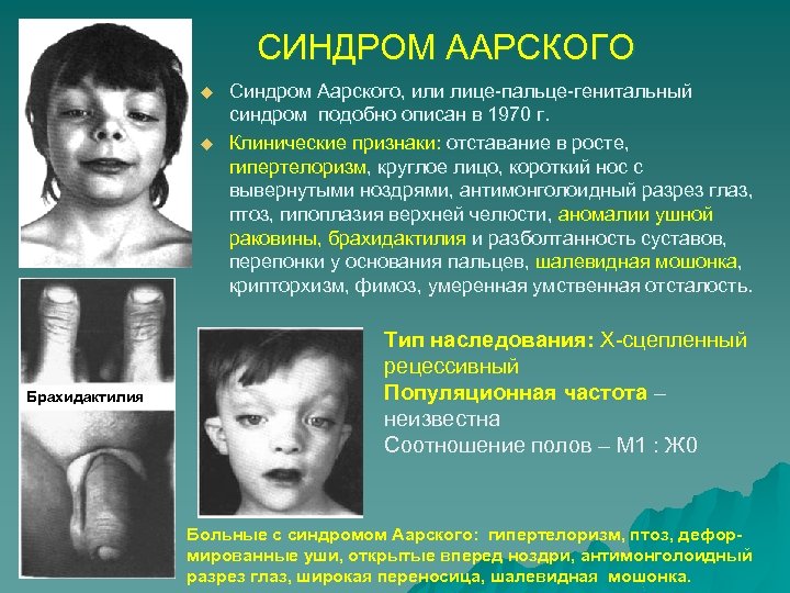 СИНДРОМ ААРСКОГО u u Брахидактилия Синдром Аарского, или лице-пальце-генитальный синдром подобно описан в 1970