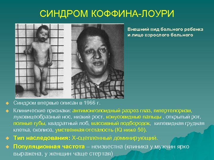 СИНДРОМ КОФФИНА-ЛОУРИ Внешний вид больного ребенка и лицо взрослого больного u u Синдром впервые