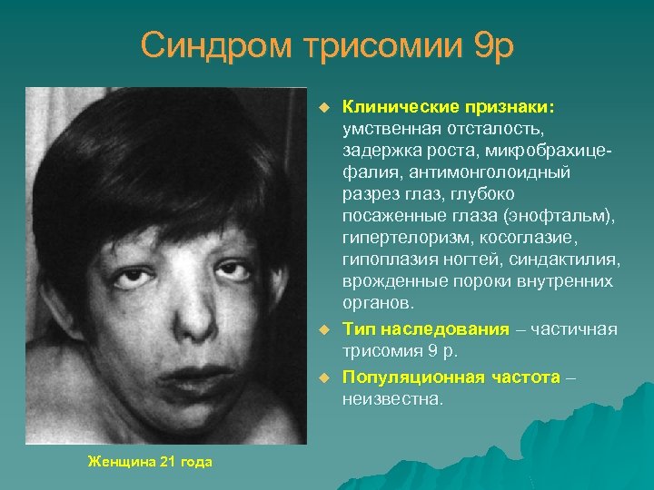 Синдром трисомии 9 р u u u Женщина 21 года Клинические признаки: умственная отсталость,